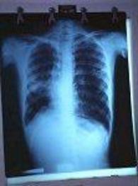 An x-ray of a patient affected by tuberculosis 