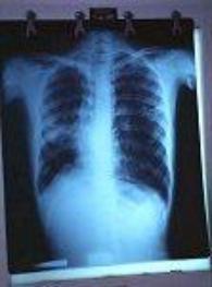 An x-ray of a patient affected by tuberculosis 