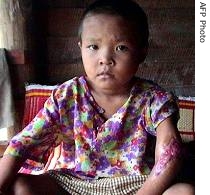 A Karen boy,6, allegedly shot in the arm by Burma military, during a massacre of villagers (File)<br />
