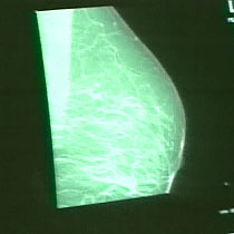 Image of (MRI imaging) breast