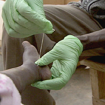 A guinea worm emerges from a young girl