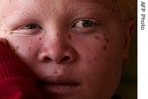 HIV positive Tommy Jarvis, 13, was abandoned in a bar as a baby and given just weeks to live by doctors seven years later in Johannesburg, 13 Jun 2007 