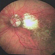 Image of the eye, Macular Degeneration, blood vessels behind retina